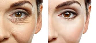 WRINKLE LASERS